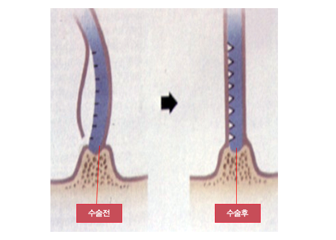 비중격 교정술