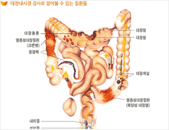 대장내시경 검사로 알아볼 수 있는 질환들