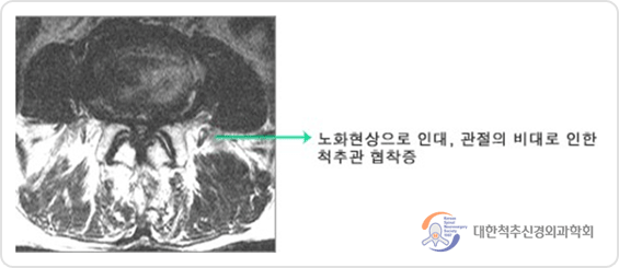 척추관협착증