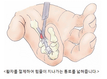 활차를 절제하여 힘줄이 지나가는 통로를 넓혀주는 수술법