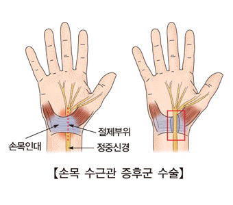 손목 수근관 증후군 수술