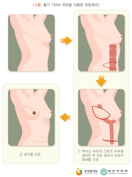 뱃살을 이용한 유방재건 이미지