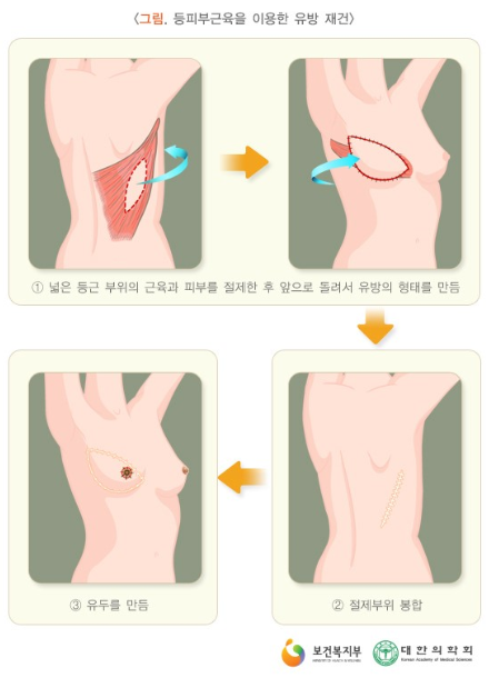 등살을 이용한 유방재건 이미지