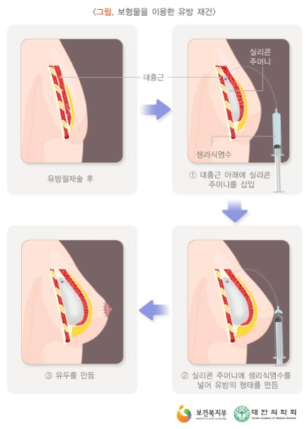 보형물을 이용한 유방재건 이미지