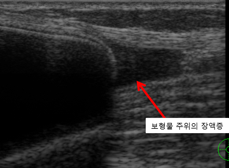 보형물초음파 및 종양절제수술