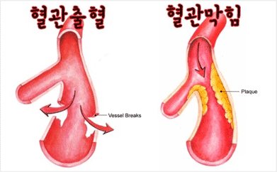 혈관출현, 혈관막힘 사진